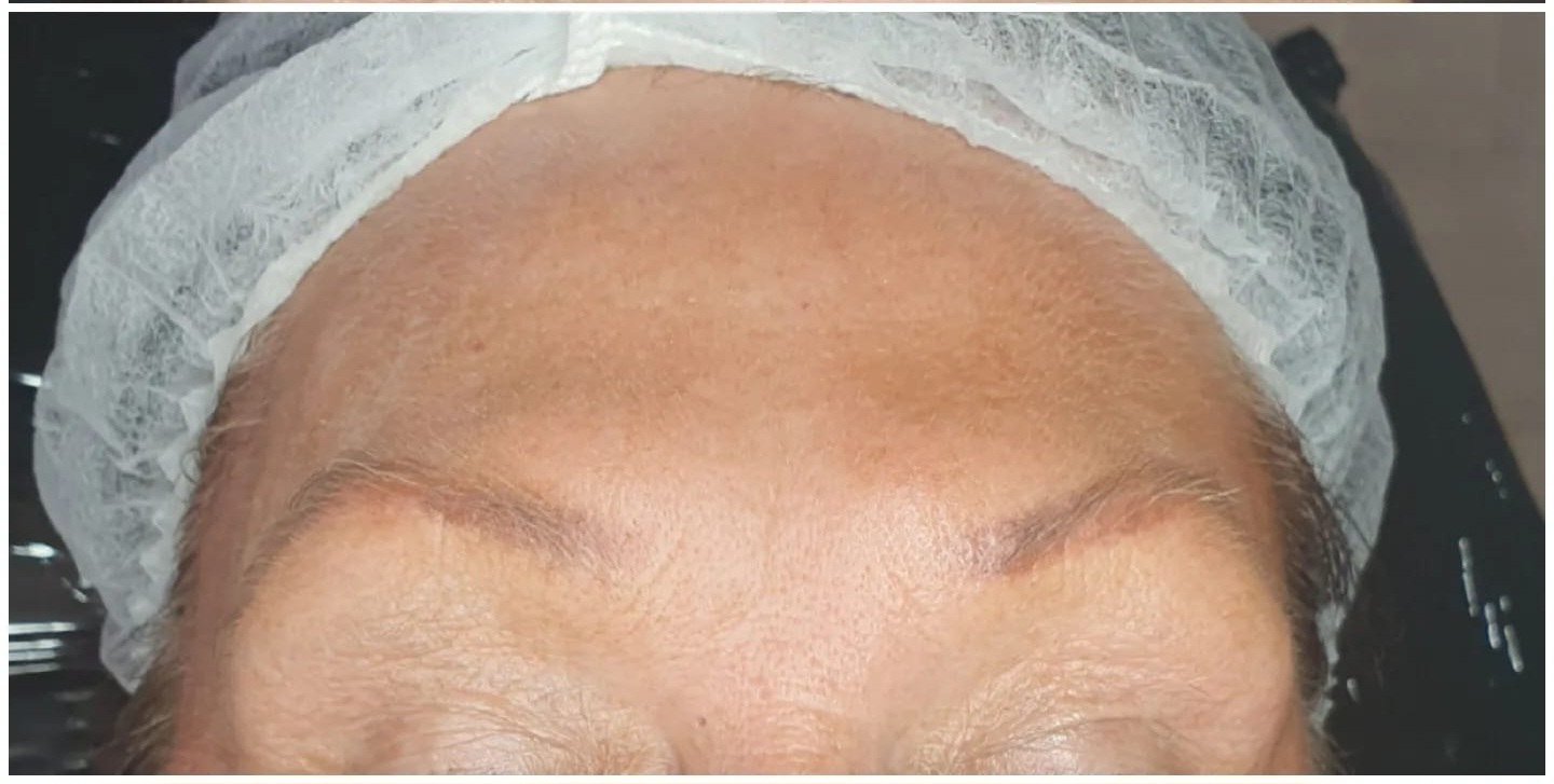 After wrinkle softening