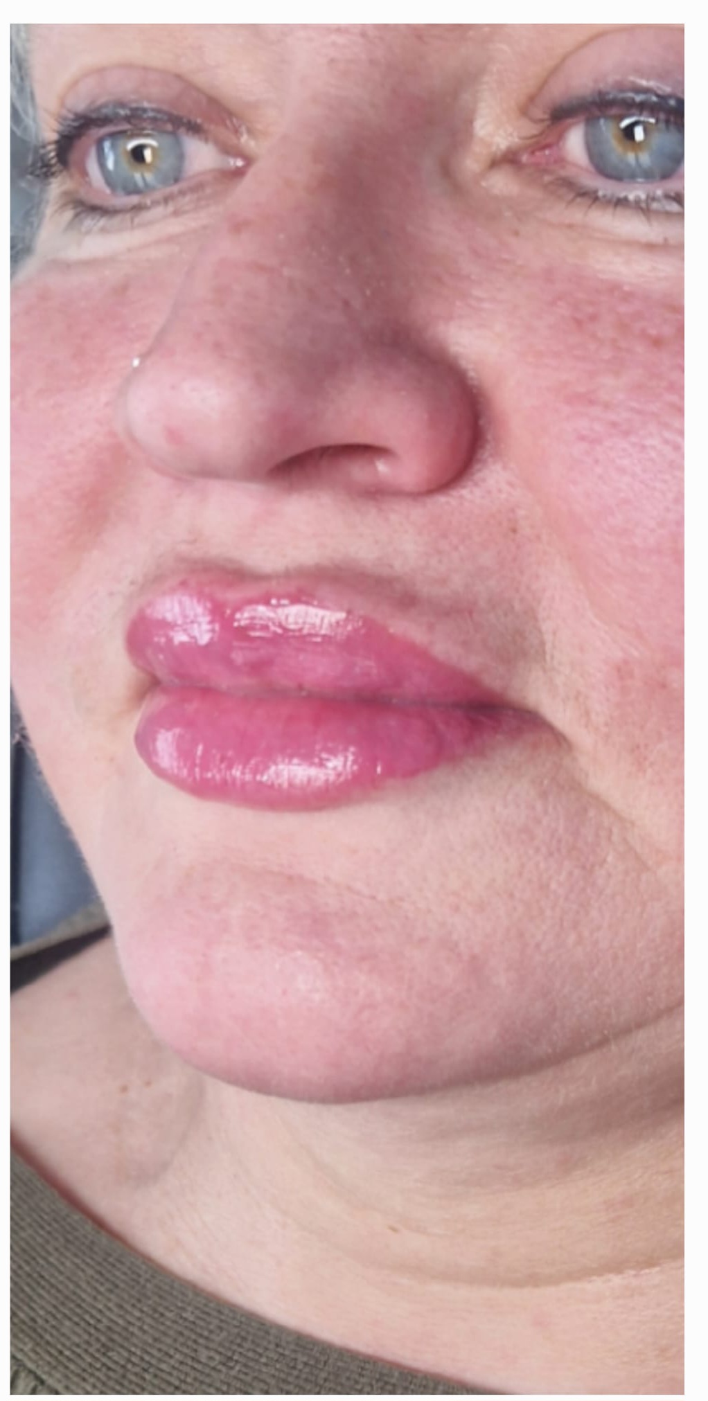 After dermal fillers