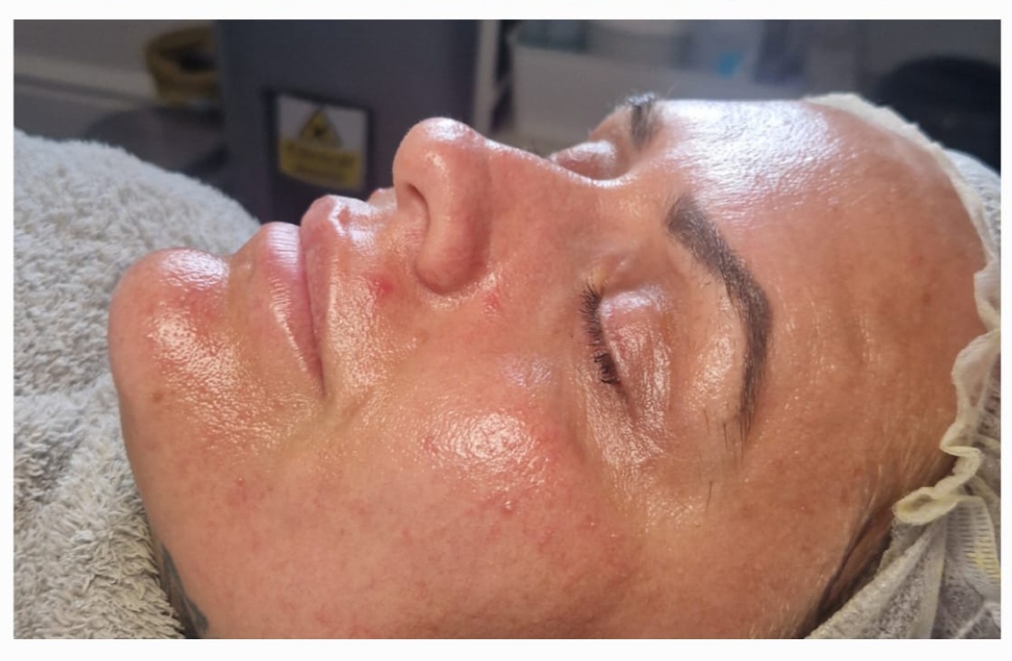 After skin health treatment