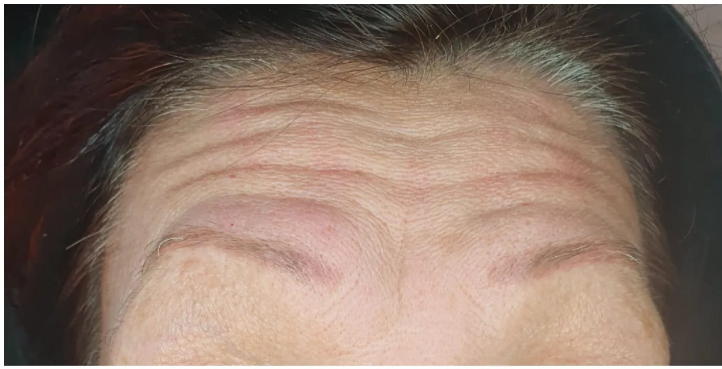 Before wrinkle softening