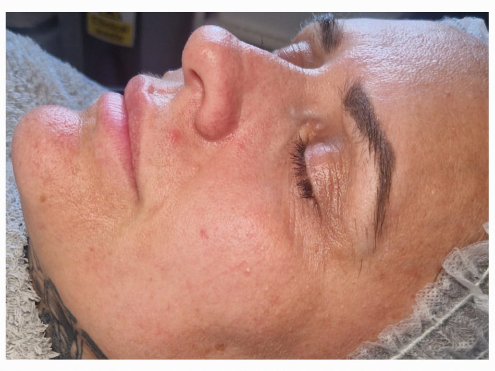 Before skin health treatment